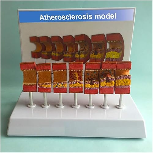 SLRMKK Artère Anatomical Model - Anatomical Vessel Athérosclérose Thrombus Vascular Model Human Arttery Anatomy Model - for Study Display Teaching Model - Nail Gallerys
