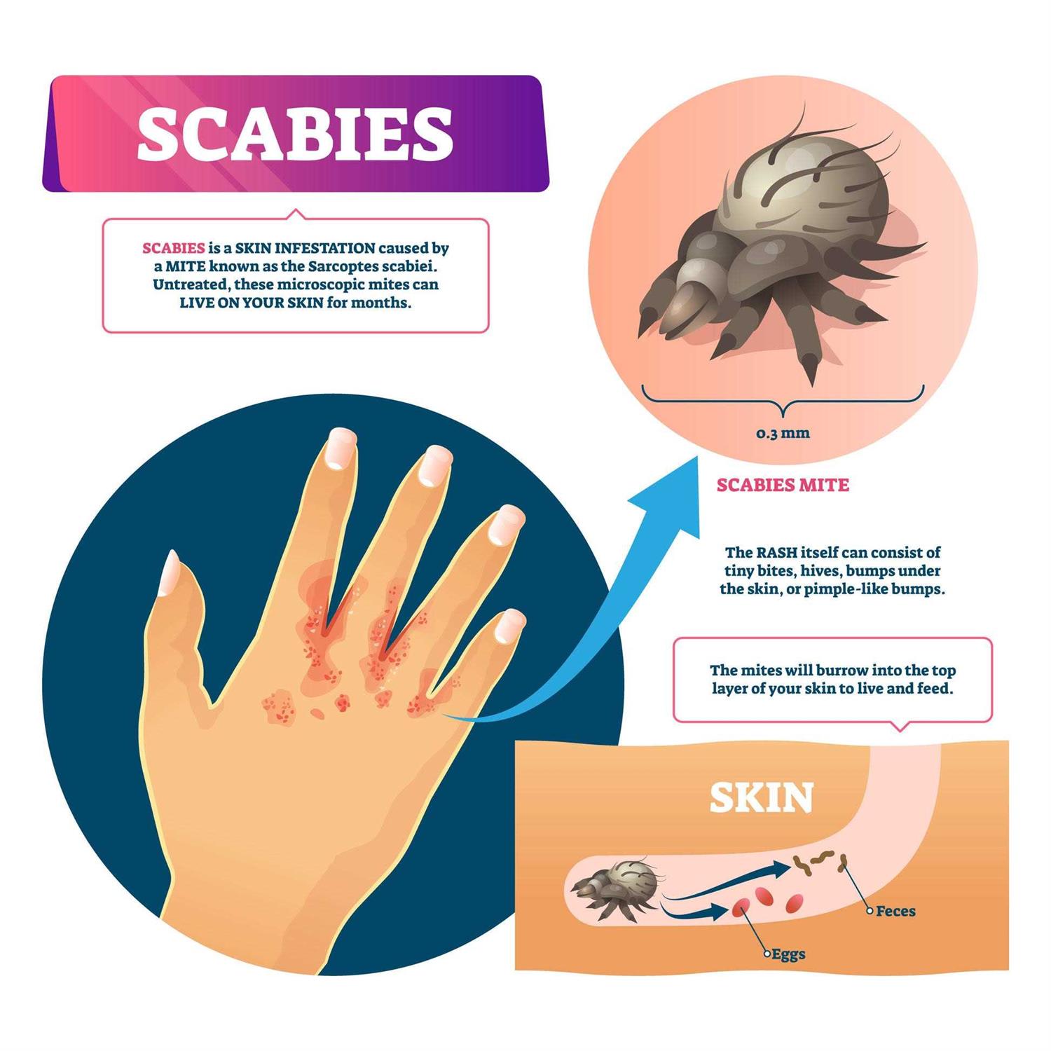 Naturasil Scabies Cream - Nail Gallerys